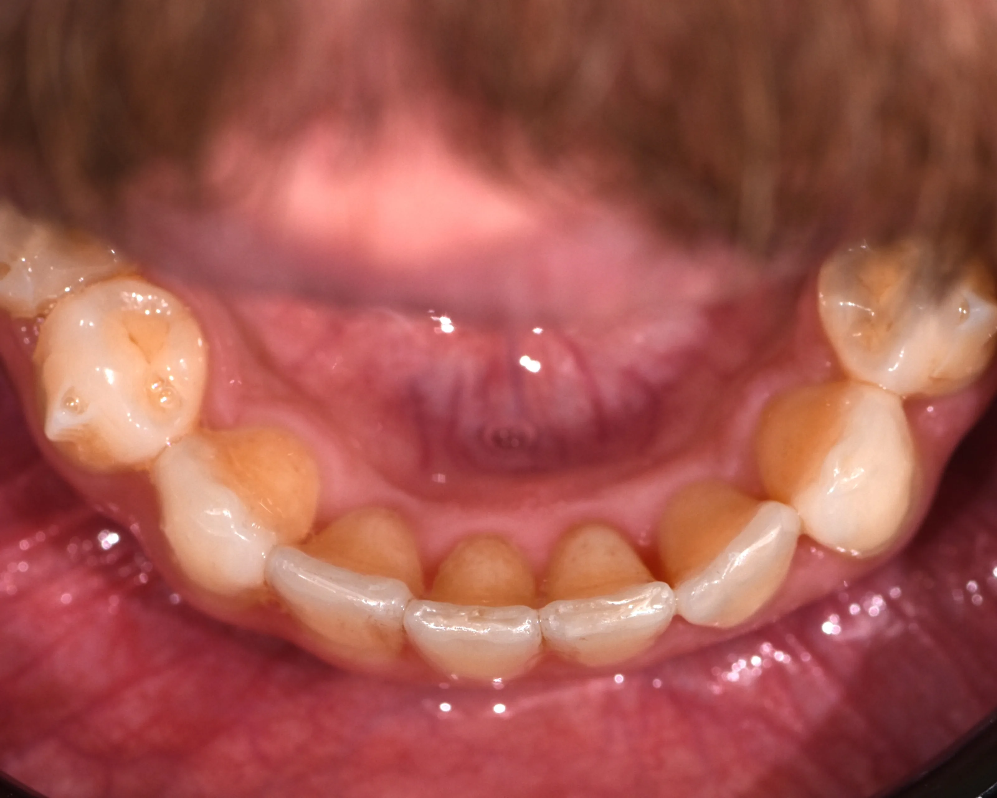 Sarah K. after treatment