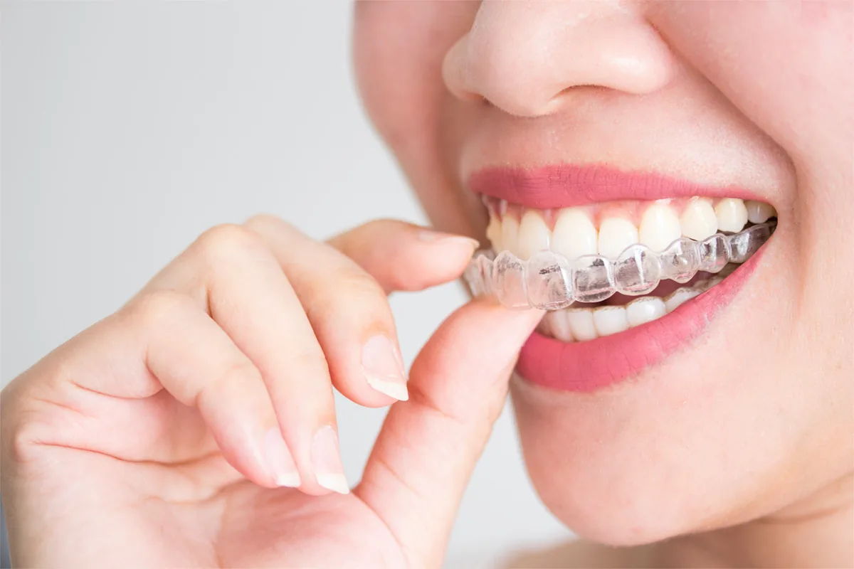 Clear aligner treatment at Mineers Smile Center Beirut