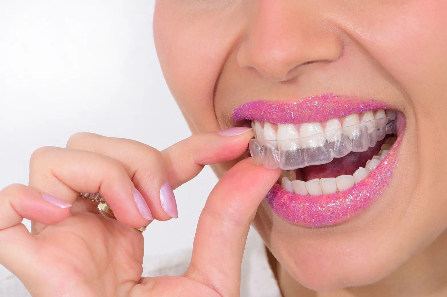 Clear Aligners