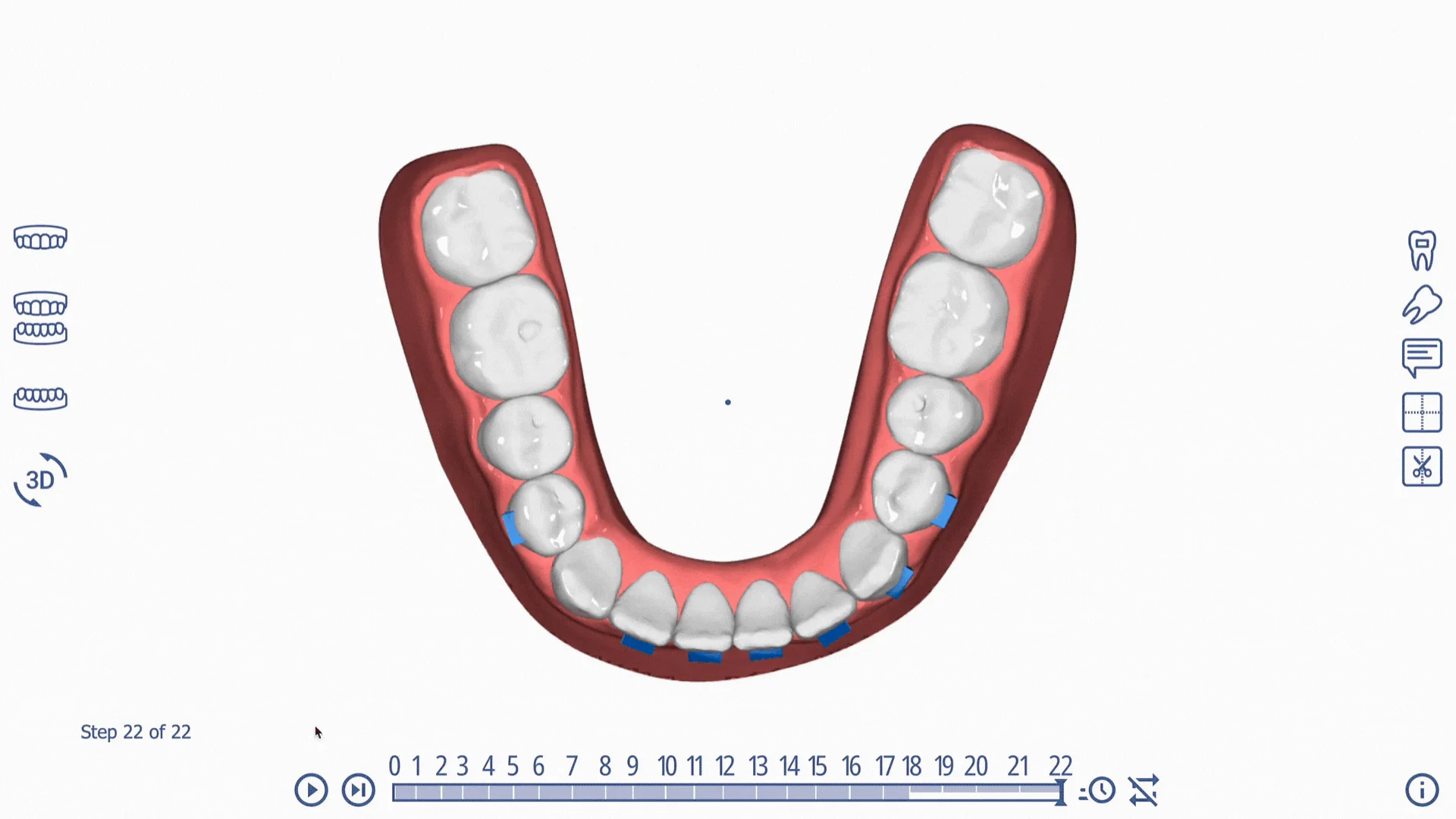 A clear aligner plan on screen, every tooth movement mapped