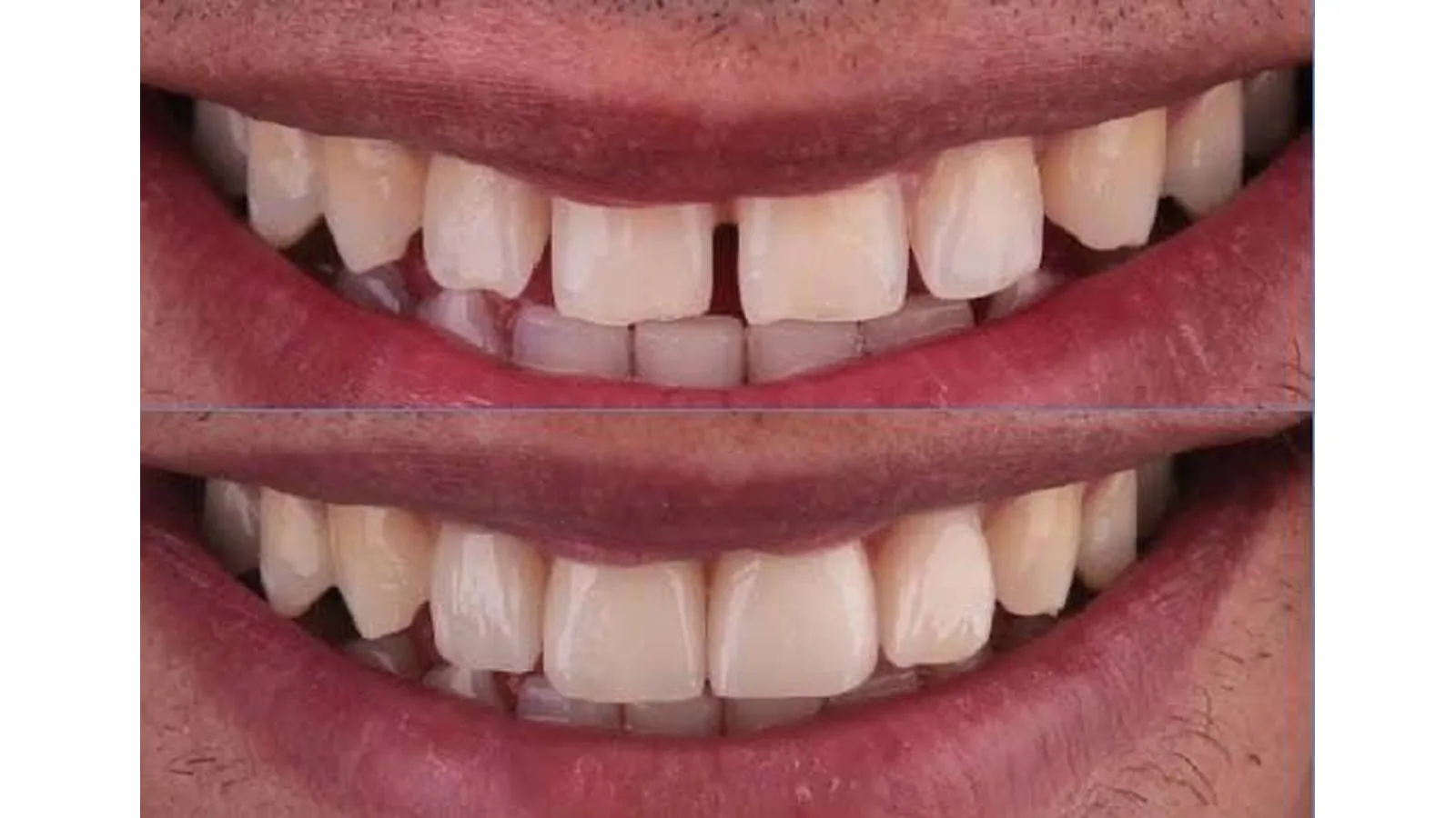 Veneer showcase