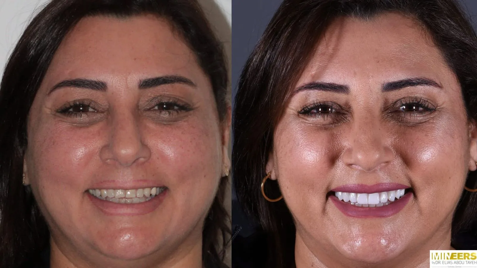 Veneer showcase