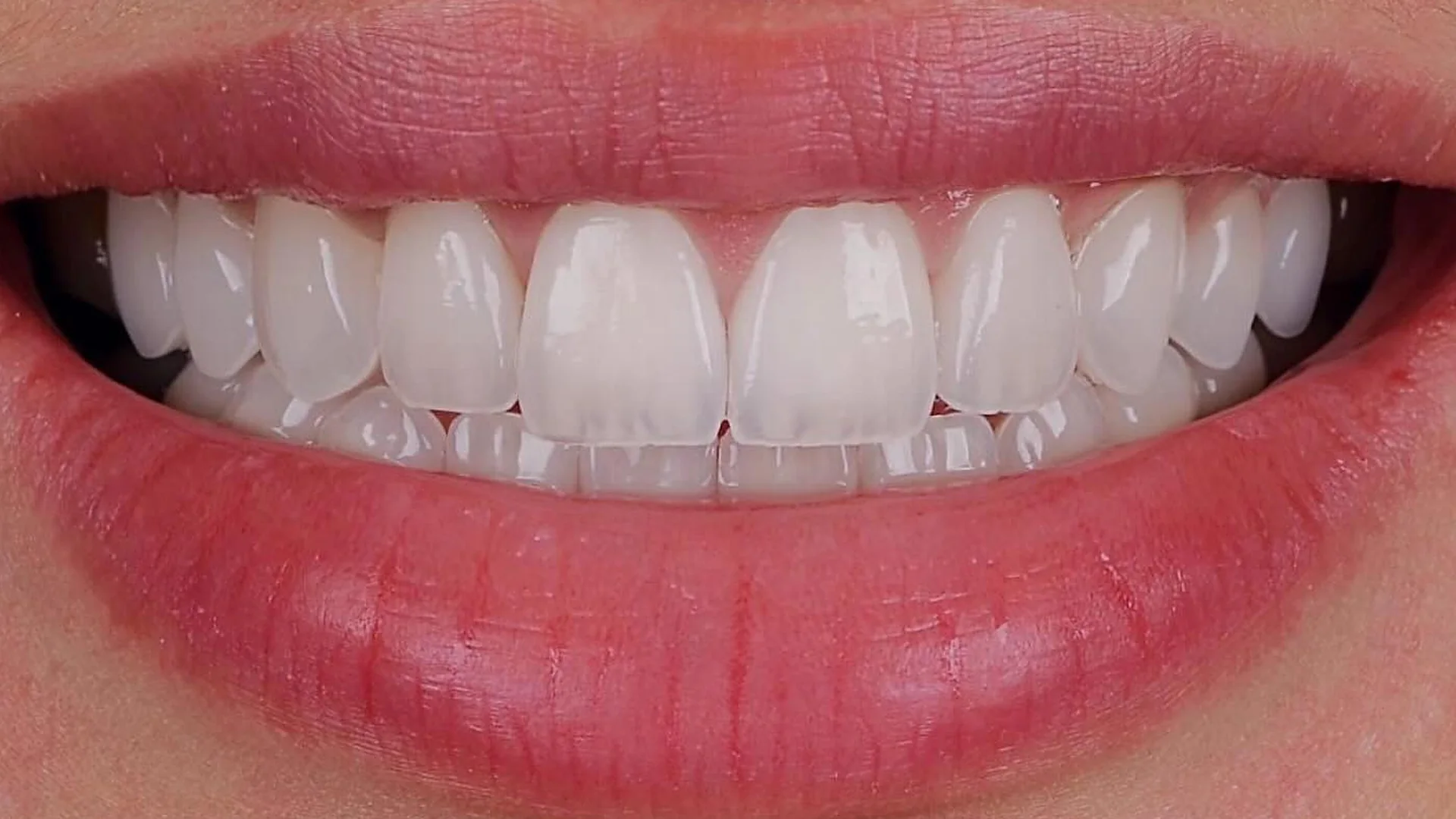 Close-up of a smile with porcelain veneers