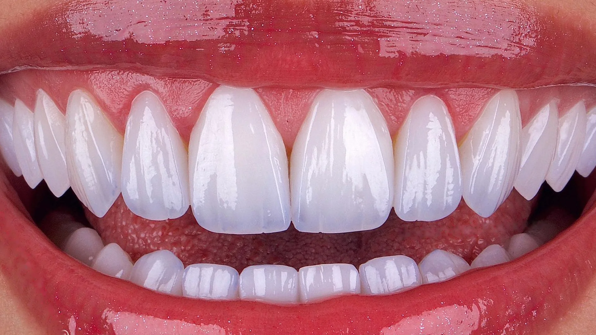 Close-up of a smile with porcelain veneers