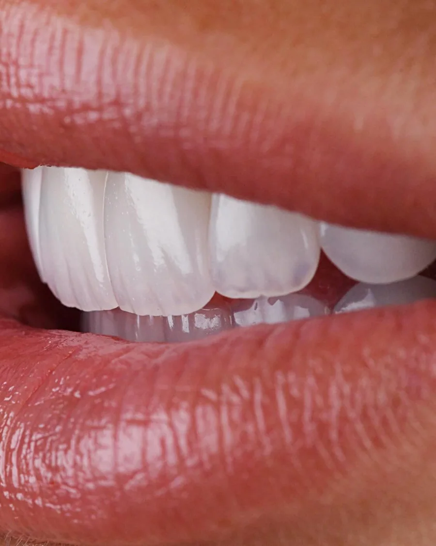 Porcelain veneers at Mineers, in profile