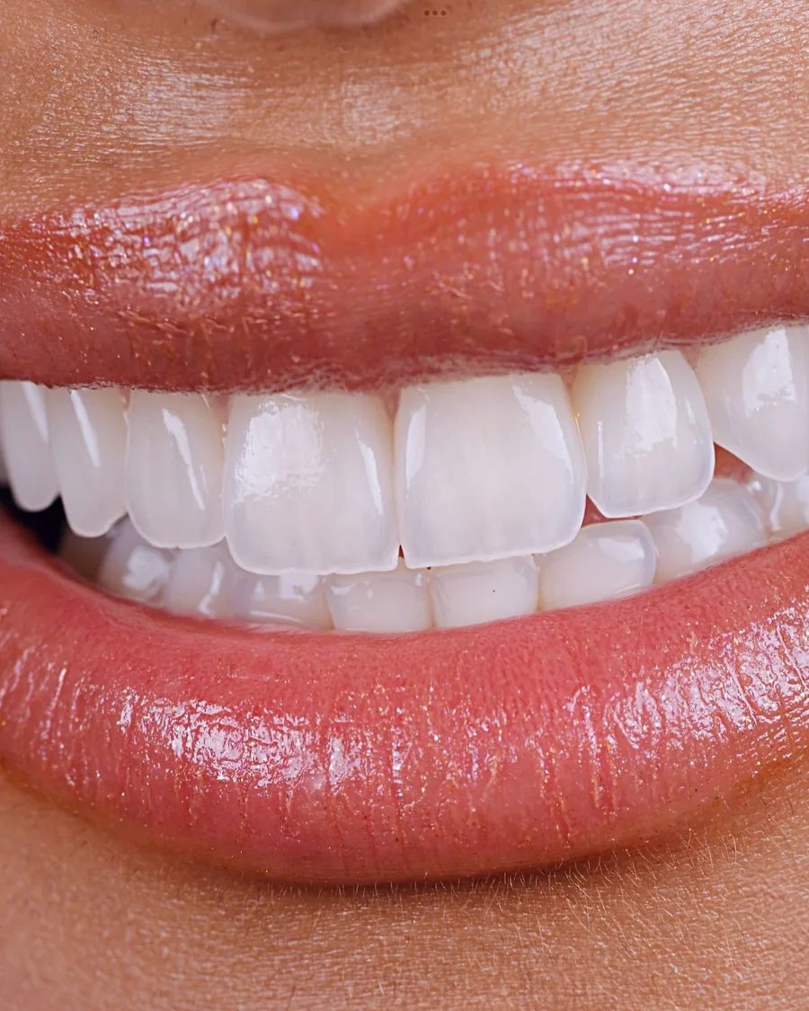 Porcelain veneers at Mineers, the upper row front on