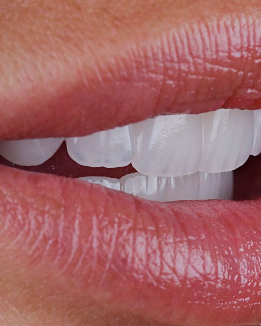 Porcelain veneers at Mineers, in profile from the other side