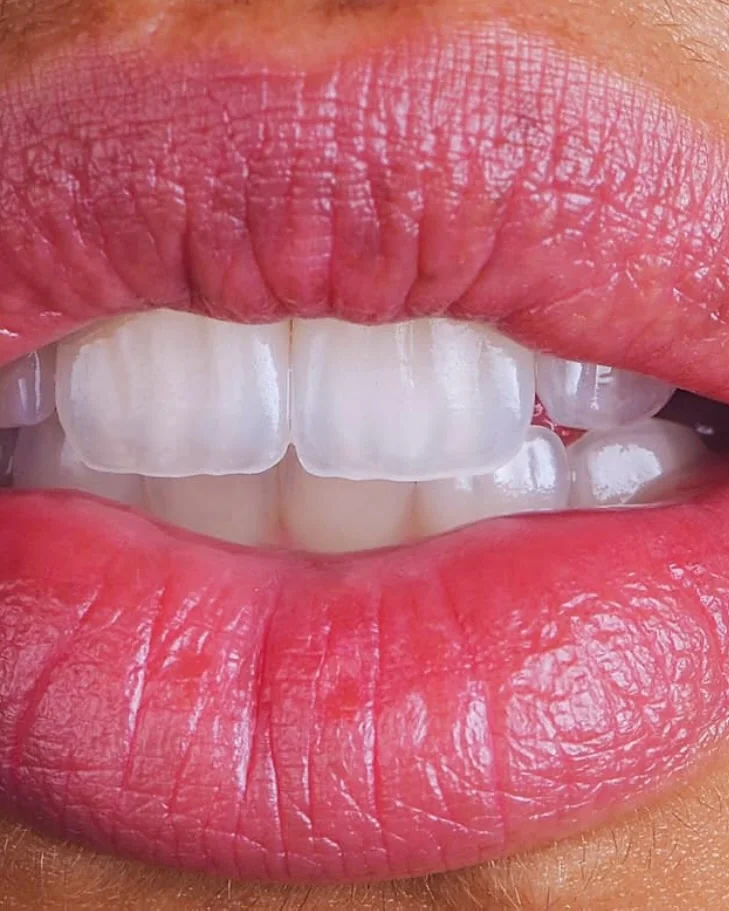 Porcelain veneers at Mineers, close up