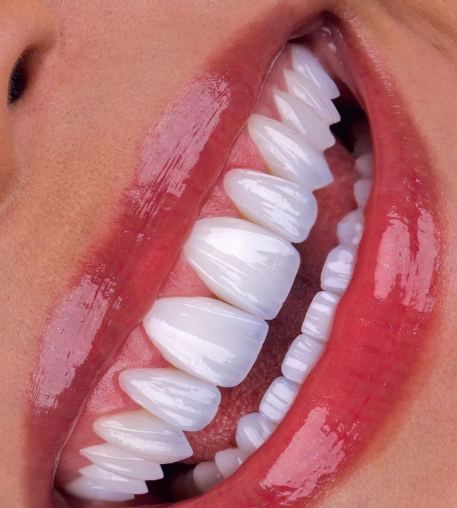 Porcelain veneers, close up