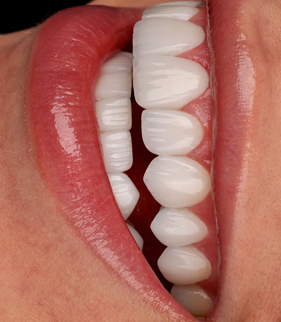 Detailed surface texture: smile design result at Mineers