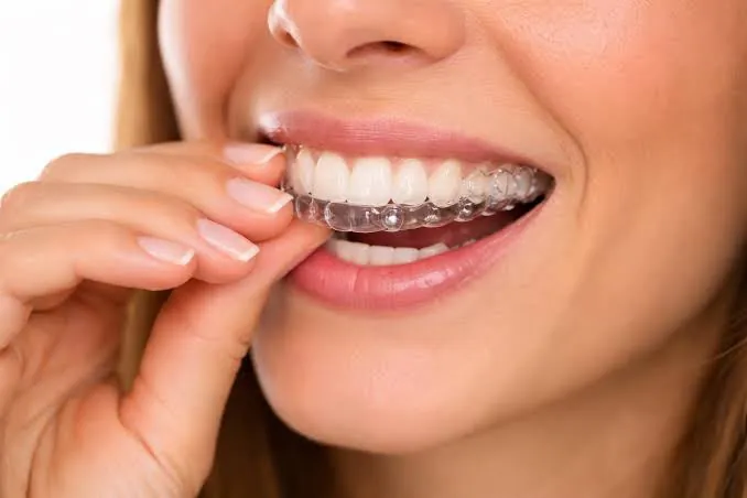 A clear aligner being put in