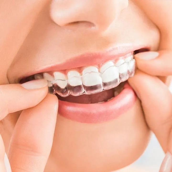 A clear aligner pressed onto the upper teeth
