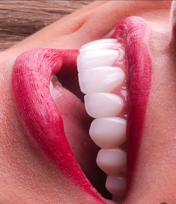 Composite veneers between red lips, close up