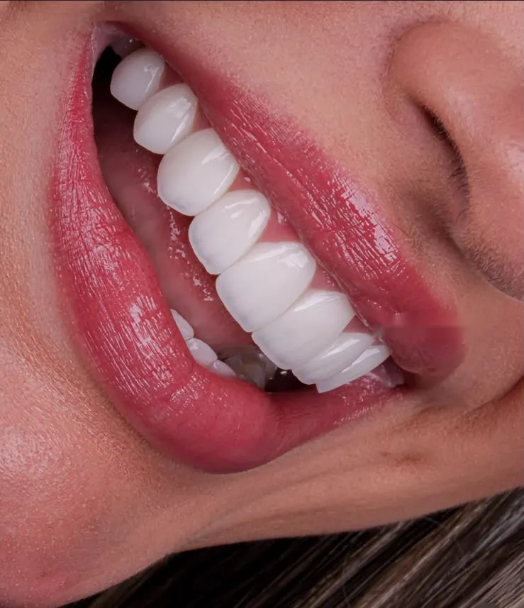 A smile with composite veneers, seen from the side