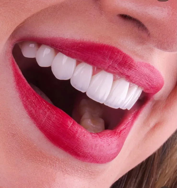 A wide, open smile with composite veneers