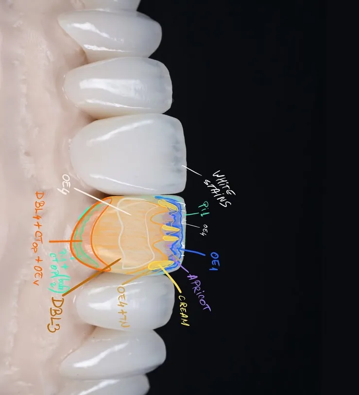 A tooth with each layer of colour marked