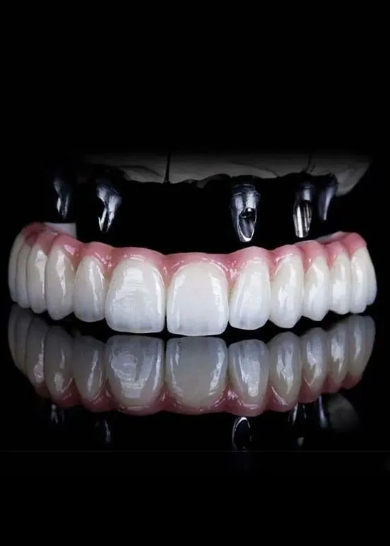 A full-arch bridge on its implant connections