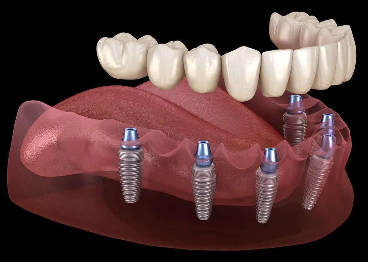A full arch of teeth on four implants, shown on a 3D model