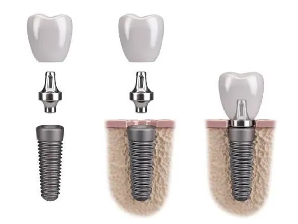 Diagram of an implant, its abutment and crown