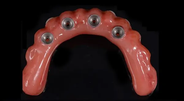 A full-arch bridge seen from below, its implant connections showing