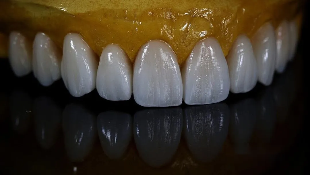 Porcelain veneers on a model, reflected on black