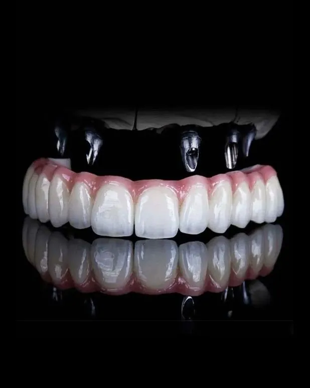 A full-arch bridge above its implants