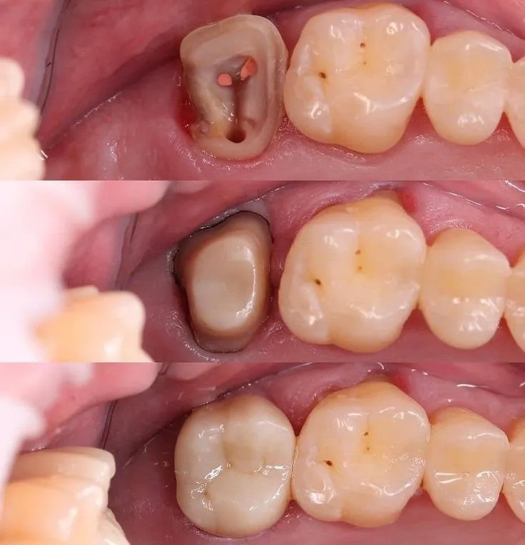 A molar after root canal treatment: the open canals, the rebuilt core, then the finished onlay