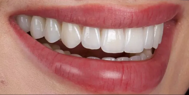 Porcelain veneers, after