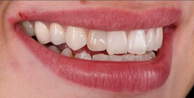 Porcelain veneers, before