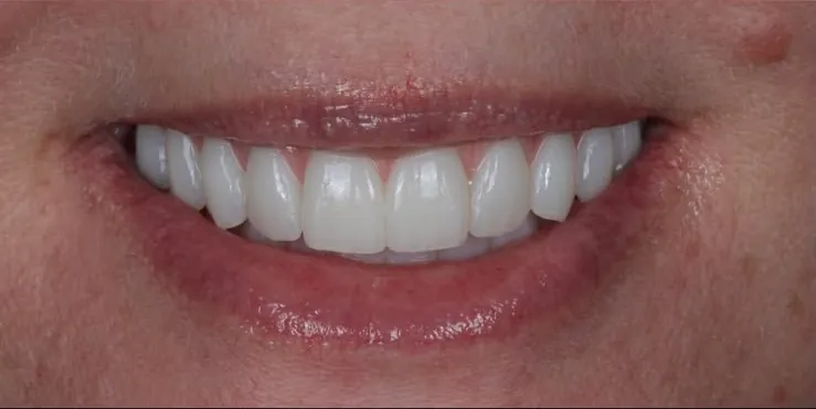 Full-arch restoration, after