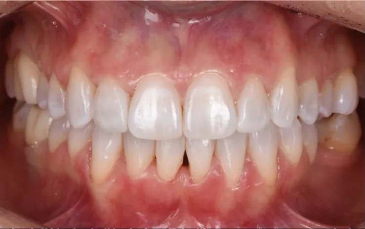 Clear aligners, whitening and bonding, after