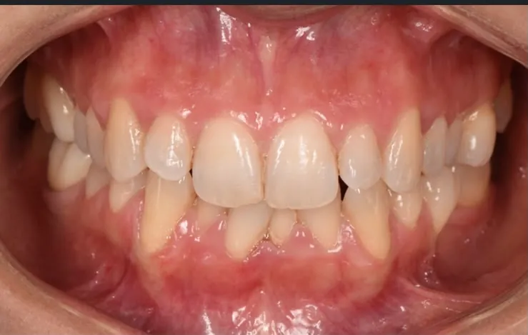 Clear aligners, whitening and bonding, before