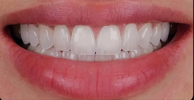 Porcelain veneers, after