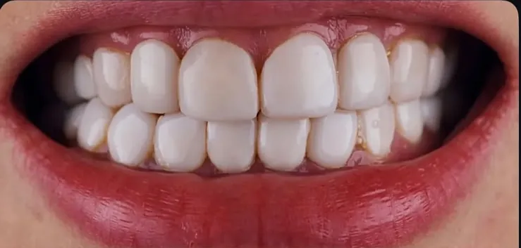 Porcelain veneers, before