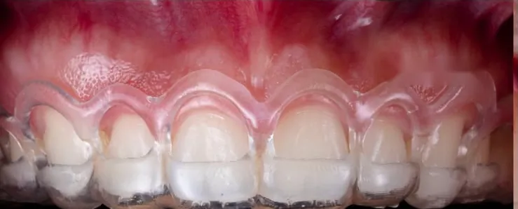 The front teeth, lips held back
