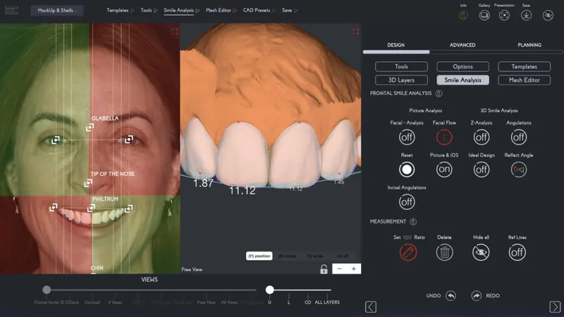 Smile design software showing the face beside a 3D model of the teeth