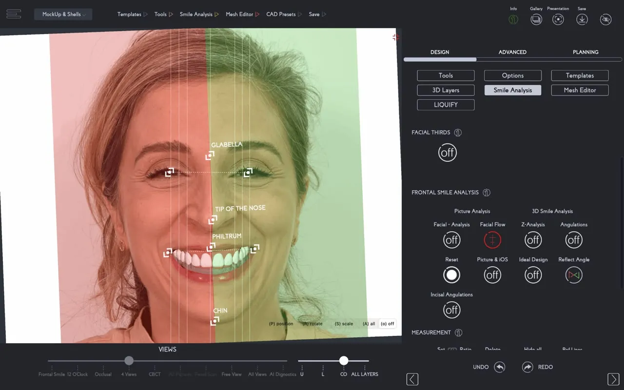 Software marking the midline and smile line on a face