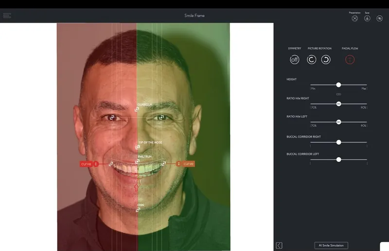Facial proportions measured in smile design software