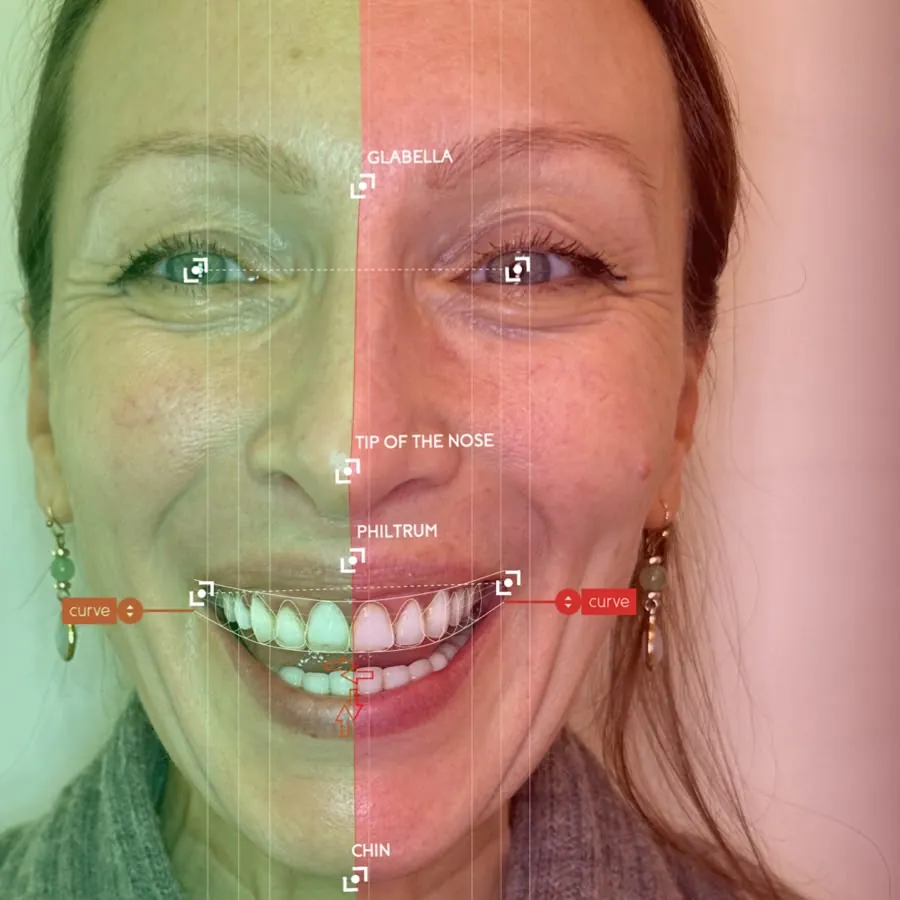 Smile design software marking the proportions of a smiling face: the midline, the smile curve and the facial landmarks