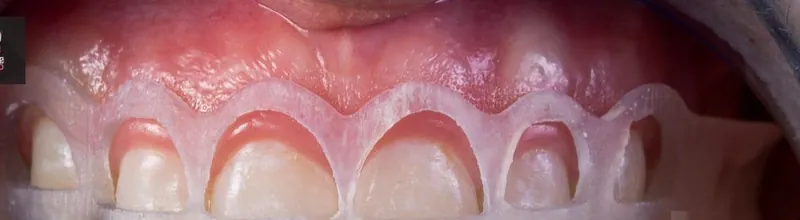 A clear mock-up key over the front teeth