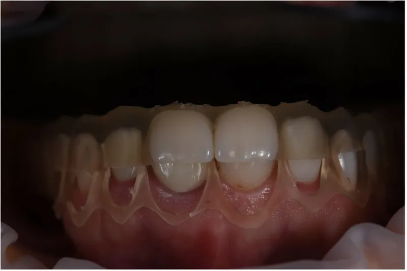 A trial smile made from the design, placed over the teeth