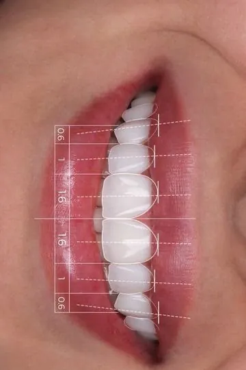Proportion lines measured across a smile, tooth by tooth
