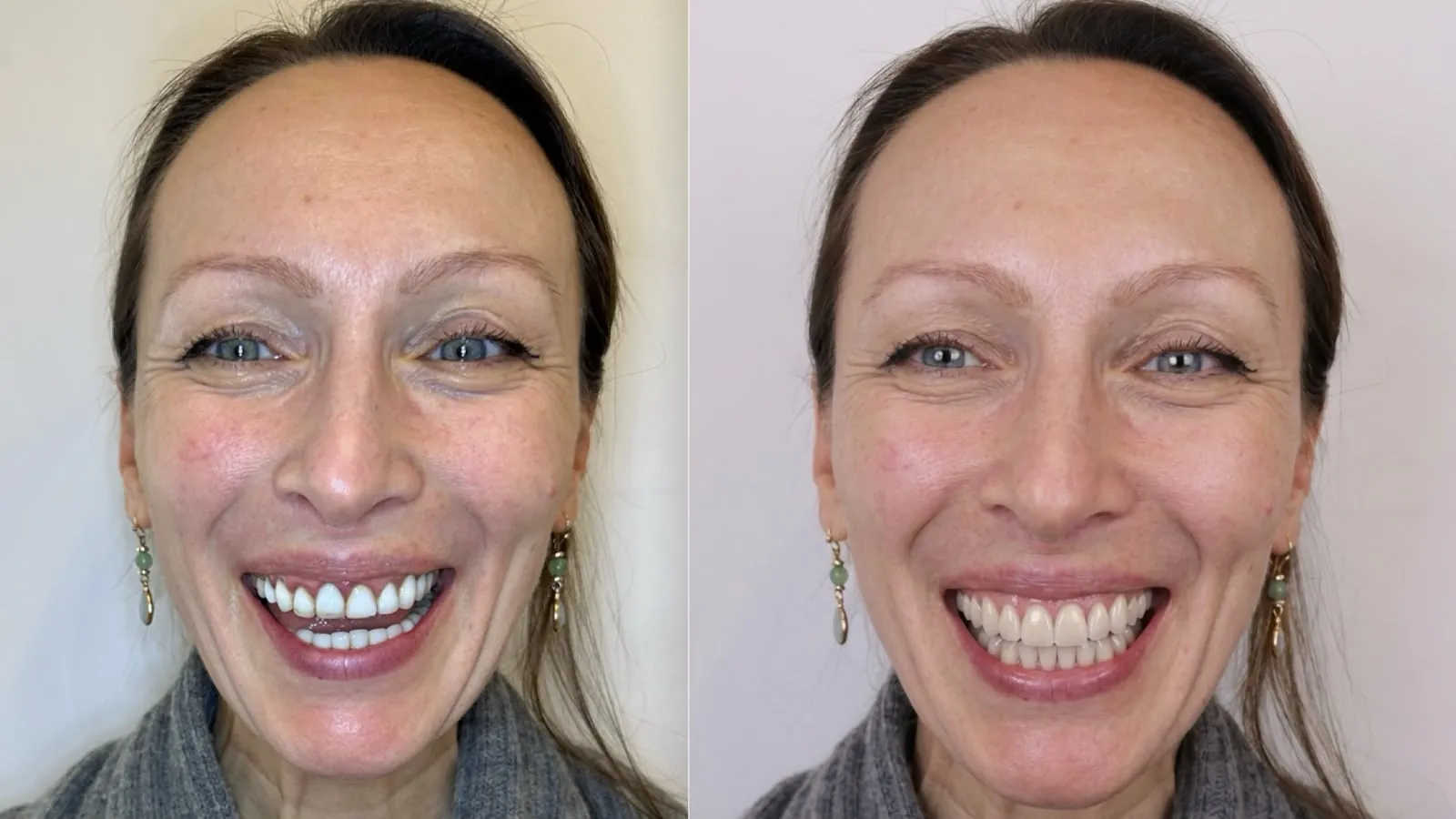 Simulation numérique d'un sourire, avant et après