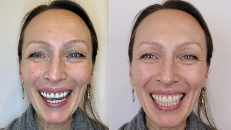 A smile as it is, beside a simulation of the designed smile