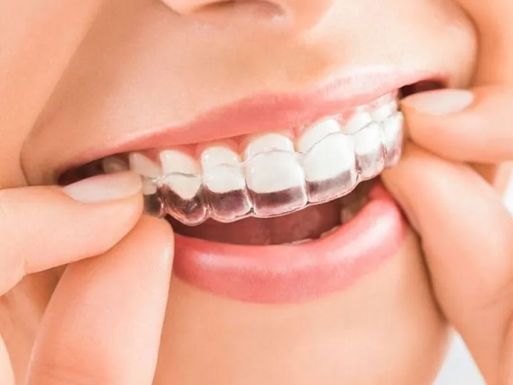 A clear aligner pressed onto the upper teeth
