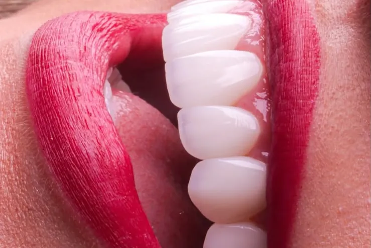 Composite veneers between red lips, close up