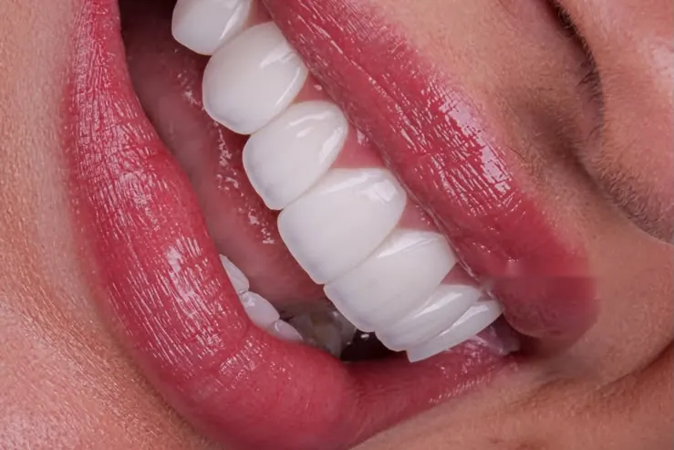 A smile with composite veneers, seen from the side