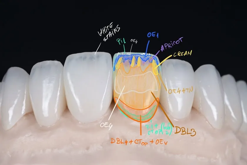 A front tooth drawn in layers of dentine and enamel shades