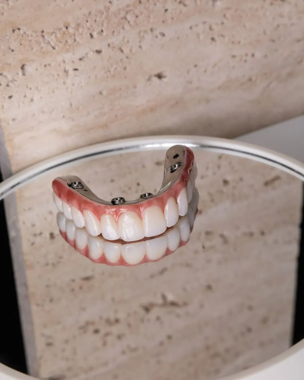 A full-arch implant bridge reflected in a round mirror