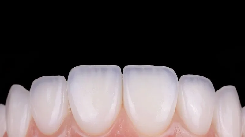 Porcelain veneers on the lower front teeth, close up